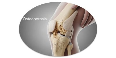 Vitamin- és ásványianyag szükségletünk - csontritkulás megelőzésére, késleltetésére