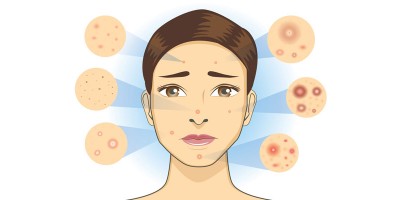 Problémás, pattanásos bőr, 30 felett?